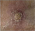 Image of Actinic Keratosis, a specific type of wart